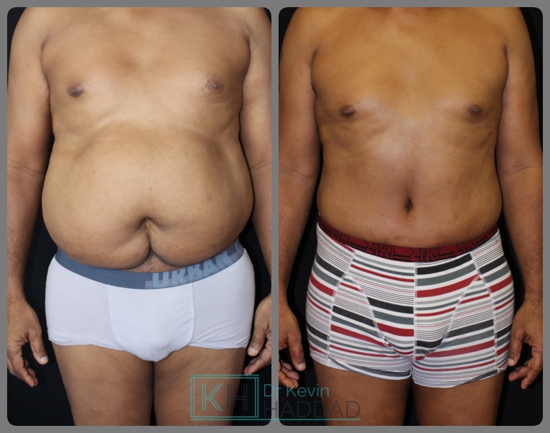 GAINE POUR ABDOMINOPLASTIE HOMME